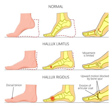 1. 10+ Hallux Limitus Rigidus Solutions: Complete Guide To Painfree Walking