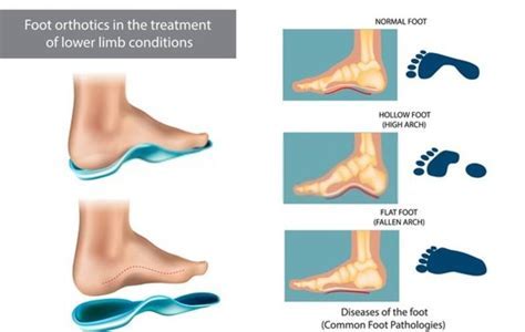 10 Ways Create Arch Support David Brown