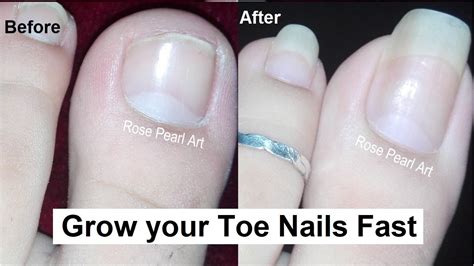 3. 5 Expert Hacks To Design A Healthy Toenail Growth Plan