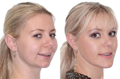 3. Maximize Your Look: 8 Pro Ideas For Upper Jaw Makeover