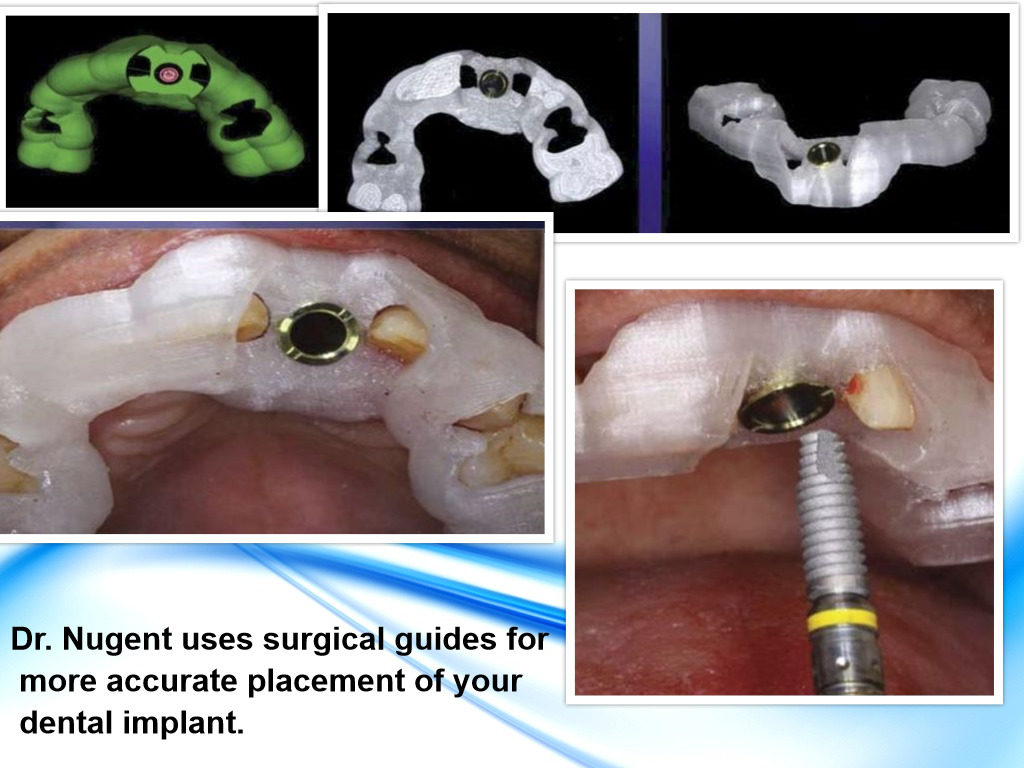 3D Guided Implant Surgery In Winchester Dentist 22601 Smiles Of Virginia