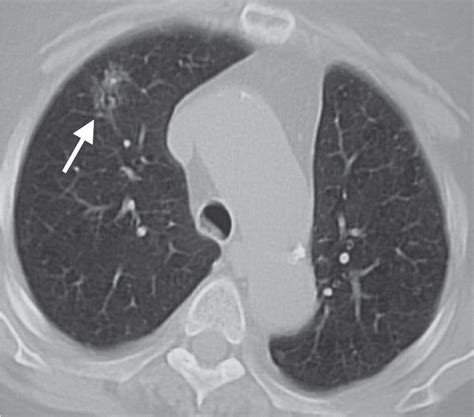 A Ct Scan Showing A 2 3 X 1 3 X 0 9 Cm Ground Glass Opacity Nodule In