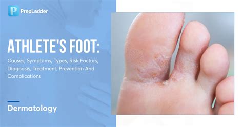 Athlete Amp 39 S Foot Symptoms Causes Treatment And Diagnosis Findatopdoc