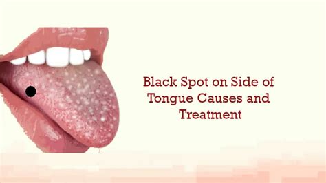 Black Dots On Tongue