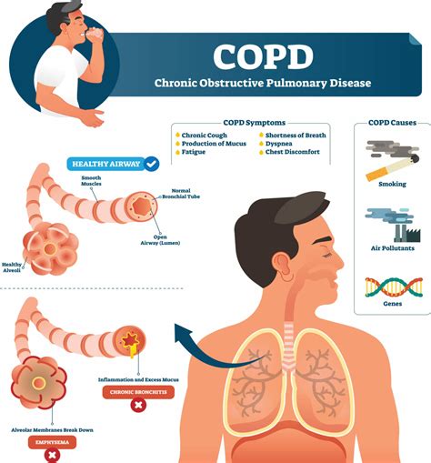 Copd Infographics