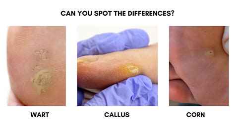 Corn Callus Vs Wart