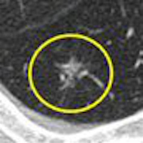 Ground Glass Nodule Features On Ct Reveal Malignancy Risk