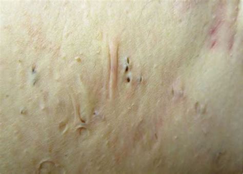 Hidradenitis Suppurativa Causes Symptoms Treatment And Surgery