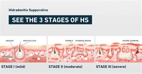 Hidradenitis Suppurativa Symptoms Severity And Stages Sharecare