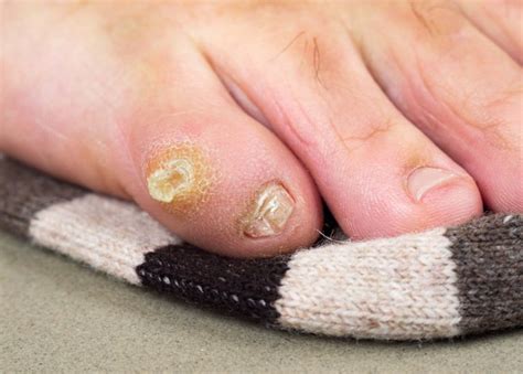 How To Get Rid Of Corn On Pinky Toe