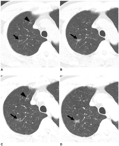 Multiple N 2 Ground Glass Opacity Nodules In Right Upper Lobe One