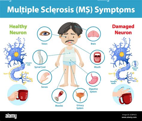 Multiple Sclerosis Ms Symptoms Early Signs Of Ms Multiple