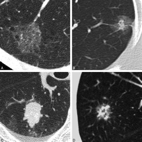 Pulmonary Adenocarcinomas Appearing As Part Solid Ground Glass Nodules