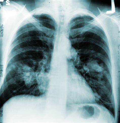 What Does Your Lungs Look Like When You Have Copd Pelajaran